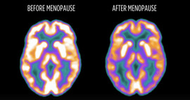 A screenshot of the brain before and after menopause from the presentation