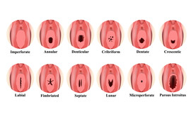 Types of vaginal coronas