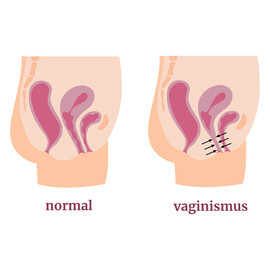 A medical model of a vagina with vaginismus and one without