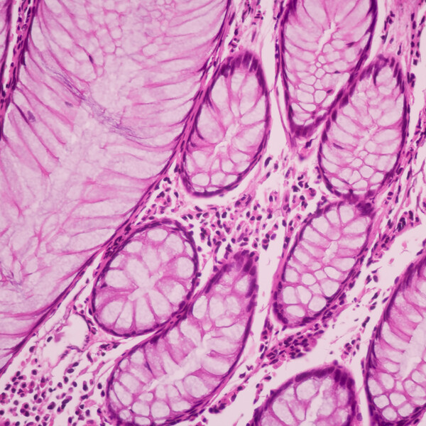 View in microscopic of ductal cell carcinoma, adenonocarcinoma from human breast cancer, tissue section by H and E stain. Pathology diagnosis. Medical concept. Under microscope, magnification 600X