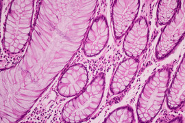 View in microscopic of ductal cell carcinoma, adenonocarcinoma from human breast cancer, tissue section by H and E stain. Pathology diagnosis. Medical concept. Under microscope, magnification 600X