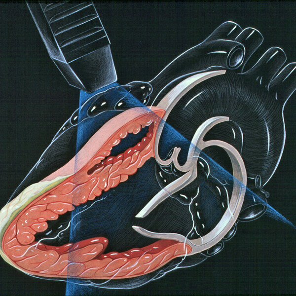 Heart_lpla_echocardiography_diagram