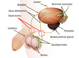 Vasectomy_diagram-en.svg