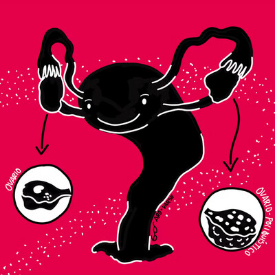 A cartoon drawing of a uterus holding on to ovaries.