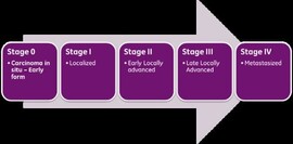 Stages of breast cancer